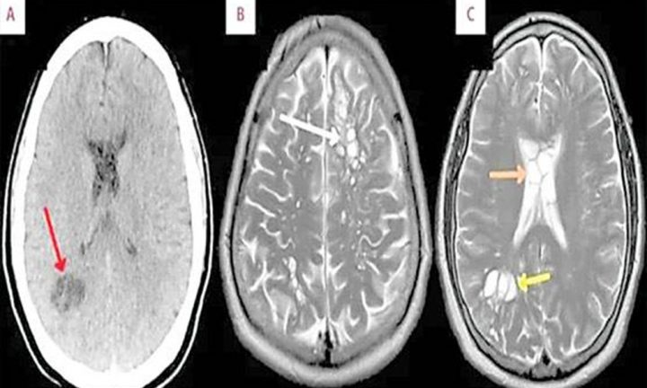 ٹیپ ورم نے دماغ کے دونوں اطراف انڈے دے رکھے تھے، فائل فوٹو